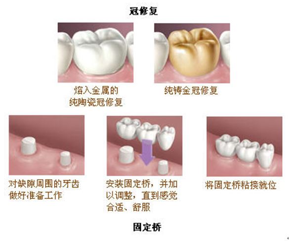 牙齿缺失的活动修复:可摘局部义齿和全口义齿,4.